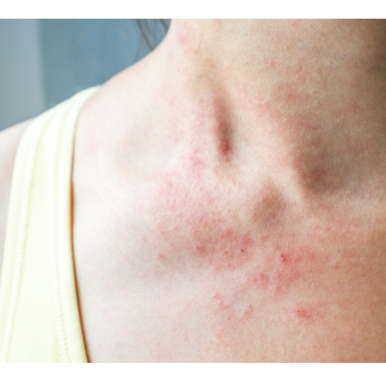 Dermatophytoses