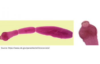 Echinococcosis
