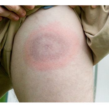Lyme disease